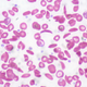 Sickle cell disease. Image: Flickr